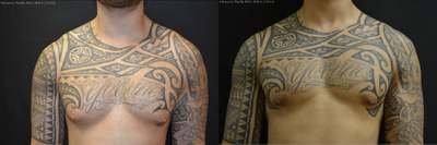 25-34 year old man treated for Male Breast Reduction - Gynecomastia treated with direct excision and liposuction