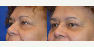 55-64 year old woman treated with Eyelid Surgery - This patient presented with frustration about the comments she received from friends and colleagues regarding her tired eyes. Dr. Ho was able to rejuvenate the look of the area by performing the lower eyelid procedure for the patient.