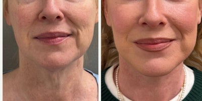 51 yo woman s/p Deep Plane Face and Neck lift performed under local anesthesia with sedation in our on site AAAA certified opera - 51 yo woman after a deep plane face and neck lift performed under local anesthesia with sedation in our on site AAAA certified operating suite
