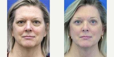55-64 year old woman treated with Brow Lift, Eyelid Surgery - She wants to appear more refreshed without the tired looking eyes. Endoscopic browlift, quad blepharoplasty accomplish this goal by raising the brow complex and in turn minimize upper eyelid skin trim. Lower blepharoplasty addresses the lower eyelid fat pads and loose skin.
