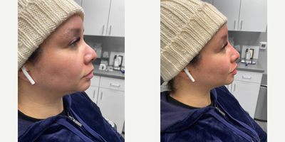 35-44 year old woman treated with Nonsurgical Nose Job - This 41-year-old patient was looking for minimal, non-invasive improvements. The doctor performed a non-surgical rhinoplasty to better define the tip of her nose. After photos were taken immediately following the injections, the patient was absolutely in awe with her new, more balanced features.