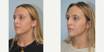 25-34 year old woman treated with Injectable Fillers - 26 year old female with Juvaderm Ultra to lips for improved volume and balance. After photo is 2 weeks following treatment.