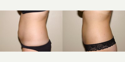 25-34 year old woman treated with Liposuction - Tumescent liposuction of the abdomen