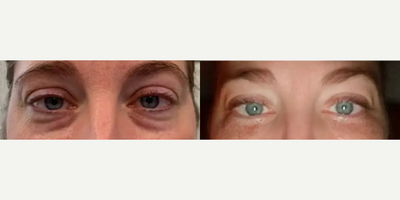 Woman treated with PlasmaPen - Woman treated with PlasmaPen