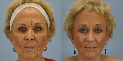 71 year old woman treated with SMAS Facelift - This 71 year old patient was treated with SMAS Facelift.