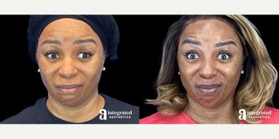 55-64 year old woman treated with Dysport - The patient is a 58-year-old female who had concerns about fine lines and wrinkles. Dr. Chiang used wrinkle relaxer (Dysport or Chotox) for the forehead, glabella, crows feet, bunny lines, chin, masseters, and neck bands to address these concerns. The after results are 3 weeks post-treatment.