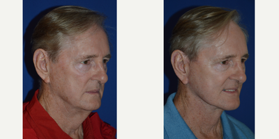 65-74 year old man treated with Neck Lift - 71 year old male after lateral SMASectomy facelift and platysmaplasty neck lift