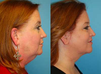 45-54 year old woman treated with Neck Lift - 48 year old woman a neck lift and facelift. Notice her improved neck contour and more youthful facial appearance. She now looks younger and feels younger. Using a limited incision approach, her temporal hairline position has not changed. The scars in front of her ears and behind the ears are barely visible and will continue to fade.