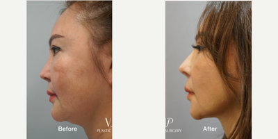 55-64 year old woman treated with Asian Rhinoplasty, Rhinoplasty, Revision Rhinoplasty, Facelift, Deep Plane Facelift, SMAS Face - 2 year post operative surgery before and after for 60-year-old female patientSurgery List:Extended deep plane faceliftNecklift, Middle neck plicationRib cartilage rhinoplasty, Mid face augmentationEndoscopic forehead & brow liftFull face fat graftingStem cell treatmentPerformed by VIP Plastic Surgery chief surgeon, Dr. Myung Ju Lee