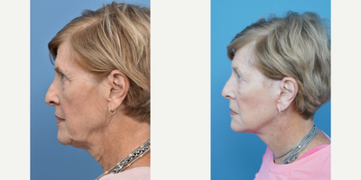 75 and up year old woman treated with Cheek Lift - This 80 year old patient was concerned with the signs of aging. A cheek lift was performed to address her concerns.