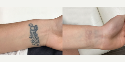 35-44 year old woman treated with Tattoo Removal, PicoWay - This 36-year-old patient wanted to remove her tattoos. To do so, 13 sessions of PicoWay were performed. Her after photos are shown 3 months after her 12th session.