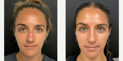 Woman treated with Rhinoplasty - Woman treated with Rhinoplasty