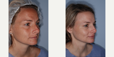 Woman treated with Lip Fillers, Lip Implants - Woman treated with Lip Fillers, Lip Implants