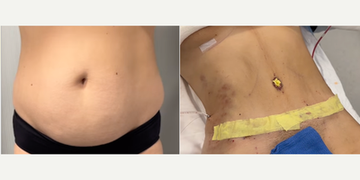 Woman treated with Tummy Tuck - Woman treated with Tummy Tuck