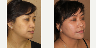 35-44 year old woman treated with Liposuction - laser cool liposuction of the neck