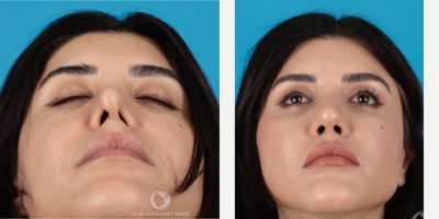 35-44 year old woman treated with Revision Rhinoplasty - This patient had a very prominent assymmetry in nostrils and crooked nose. Her left nostril was completely closed. All these imperfections were fixed by revision rhinoplasty.