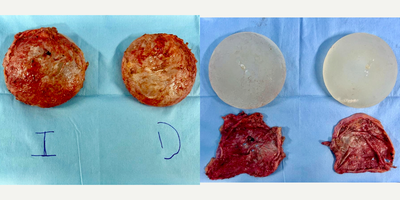 55-64 year old woman treated with Capsular Contracture Treatment, Breast Implant Removal - Famale patient with breast implant illness (BII) and Asia syndrome and implant malposition. She had an Enbloc capsulectomy with inframammary approach.