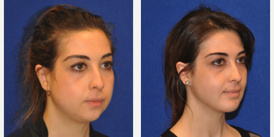 Chin Implant - Chin Implant