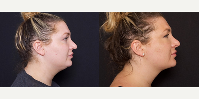 Woman treated with FaceTite - Woman treated with FaceTite