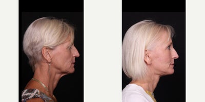 55-64 year old woman treated with Facelift, Neck Lift, Brow Lift, Facial Fat Transfer - One of our favorite patients underwent some of our favorite procedures 3 months ago including deep plane face and neck lift, brow lift, and facial fat grafting. She's healing beautifully as the laser and fat grafting continue to settle. Excited to see further refinement in the next few months ahead.