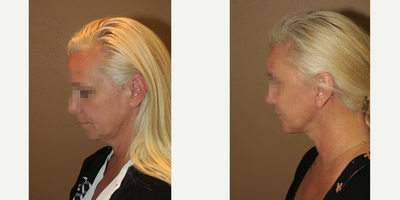 45-54 year old woman treated with Facelift - facelift