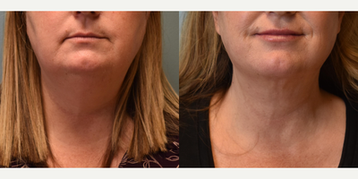 45-54 year old woman treated with Chin Liposuction - 52 year old female 6 months post Chin Liposuction.