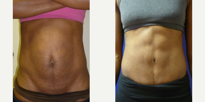 25-34 year old woman treated with Abdominal Etching - An athletic woman in her early 30s gave birth to twins and developed stretch marks and redundant skin that would not improve with exercise. She underwent abdominal etching and short-incision abdominoplasty.