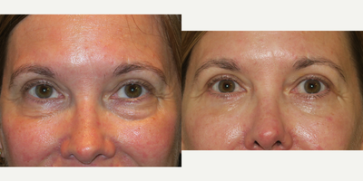 35-44 year old woman treated with Eyelid Surgery - lower blepharoplasty