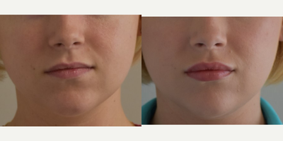 35-44 year old woman treated with Juvederm - Lip Augmentation in New Orleans by Dr Sean Weiss - Facial Plastic Surgery