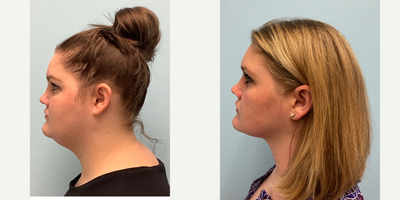 18-24 year old woman treated with Chin Liposuction - A combination of extended neck liposuction (jawline sculpting)