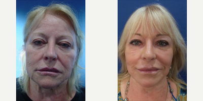 65-74 year old woman treated with Laser Resurfacing - 72 year old female 3 months status post cool helium plasma laser resurfacing in order to improve facial aging and sun damage.
