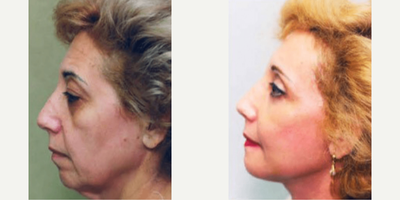 Woman treated with Facelift - Woman treated with Facelift