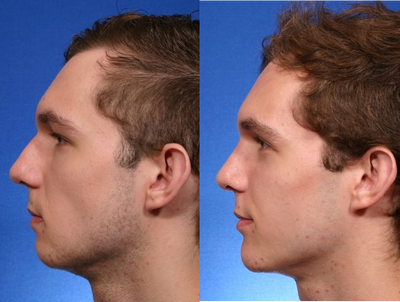 Chin implant combined with rhinoplasty - A chin implant can add definition to the jawline. Often times chin augmentation is combined with rhinoplasty to improve the profile. The implant is inserted via a small incision inside the mouth or under the chin and can be placed in approximately 45 minutes.
