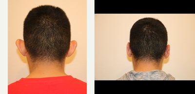 25-34 year old man treated with Ear Surgery - This 27-year-old male is one week after undergoing bilateral otoplasty. The primary objective in correcting this young mans prominent ears, is to establish an anti-helical fold. He was born without this critical bend in his upper and middle ear cartilage. This procedure is accomplished by placing buried sutures through an incision behind the ear in the natural skin crease.