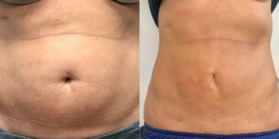 35-44 year old woman treated with BodyTite - Pt treated with bodytite with liposuction