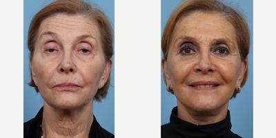 73 year old woman treated with Facelift and Ptosis Surgery - Facelift and Ptosis Eyelid Surgery