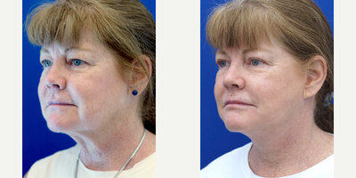 55-64 year old woman treated with Facelift - This lady desires a natural look to her neck without attracting too much attention. In-office surgical necklift rejuvenates her lower face upper neck region for a refreshed appearance without the over-pulled look.