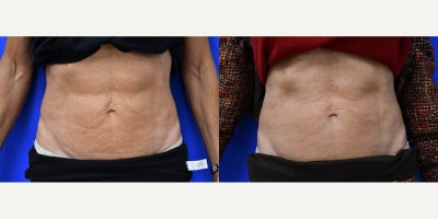 55-64 year old woman treated with Ellacor - This patient' had Ellacor to her abdomen. This picture was taken 6 weeks after 2 Ellacor treatments. The skin already looks less wrinkly!