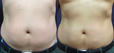 45-54 year old man treated with SculpSure - Physician selfie. Before and 8 weeks after one 4 panel treatment with Sculpsure