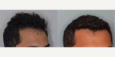 Man treated with FUE Hair Transplant - Before and after 1200 FUE grafts to reinforce and lower the hairline.