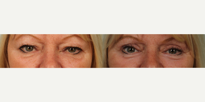 55-64 year old woman treated with Eyelid Surgery - Upper and Lower Eyelid Surgery
