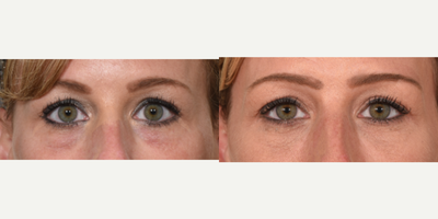 Tear Trough Filler - Patient treated her under eyes by injecting filler into her tear troughs.