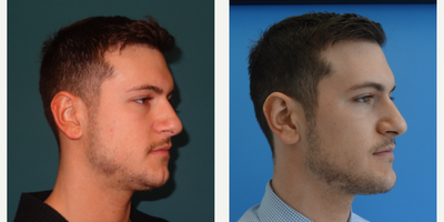 25-34 year old man treated with Chin Implant - The patient desired a more contoured neck, jaw line and chin projection. He was unhappy with the contour irregularities from his jaw line to chin and the fat pocket in his central neck. He underwent neck and jaw line liposuction for contouring and placement of a 5mm extended medpore chin implant. The implant was contoured on table and notice how his transition (where the bare patch of skin is) is smooth.