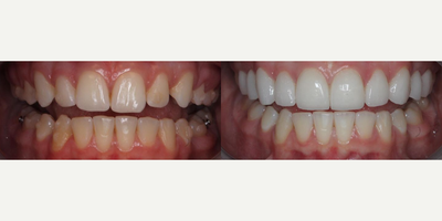 Woman treated with Teeth Whitening - Woman treated with Teeth Whitening as well as Porcelain Veneers (10 minimal/no-prep veneers) for smile enhancement. She previously had Invisalign but was still dissatisfied with the appearance of her teeth.