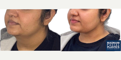 25-34 year old woman treated with Chin Liposuction, Buccal Fat Removal - 28 y.o female who was concerned with fullness in her buccal area and double chin chin appearance underwent Facial Slimming Surgery which combines buccal fat removal with chin and neck liposculpting. At 2 months post-op, sought a more well defined cheek secondary to buccal fat removal. Her double chin is gone and he jawline is significantly improved.