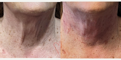 65-74 year old woman treated with Thread Lift - Non-surgical neck lift and rejuvenation and removal of vertical neck lines with PDO Threads and ThreadLift