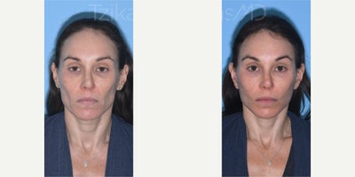 Woman treated with Brow Lift, Fractional Laser, Mini Facelift - Can you guess the secret behind my patients stunning transformation? Temporal Browlift: Lifts and revives those brows, giving the eyes a fresh, youthful look.eCO2 Fractional Laser: Smooths away those pesky lower eyelid wrinkles for a more radiant appearance.Lipografting (Nano/Micro): Have you ever wondered about the magic of nano and micro? Its simple - nano and micro refer to the size of fat graft particles used in the procedure. Theyre like tiny sculptors, adding just the right volume to cheeks and lips for a flawlessly natural contour.Mini Lift: Say hello to a tighter, more defined lower face and jawline!#minifacelift #lipografting #fractional_laser #browlift #tzikasmd #facialplasticsurgeon #plasticsurgerymiami #plasticsurgerydelray