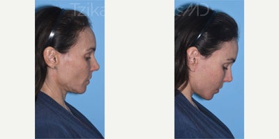 Woman treated with Brow Lift, Fractional Laser, Mini Facelift - Can you guess the secret behind my patients stunning transformation? Temporal Browlift: Lifts and revives those brows, giving the eyes a fresh, youthful look.eCO2 Fractional Laser: Smooths away those pesky lower eyelid wrinkles for a more radiant appearance.Lipografting (Nano/Micro): Have you ever wondered about the magic of nano and micro? Its simple - nano and micro refer to the size of fat graft particles used in the procedure. Theyre like tiny sculptors, adding just the right volume to cheeks and lips for a flawlessly natural contour.Mini Lift: Say hello to a tighter, more defined lower face and jawline!#minifacelift #lipografting #fractional_laser #browlift #tzikasmd #facialplasticsurgeon #plasticsurgerymiami #plasticsurgerydelray