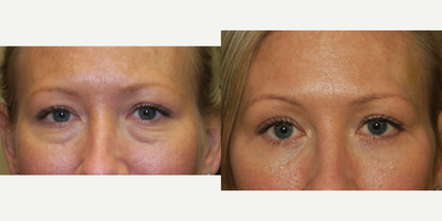 35-44 year old woman treated with Eyelid Surgery - lower blepharoplasty