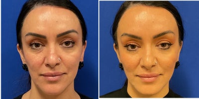 35-44 year old woman treated with Cheek Fillers, Dermal Fillers - 43 yo female who underwent cheek, jawline, and chin contouring with Juvederm filler. 2 weeks between before and after